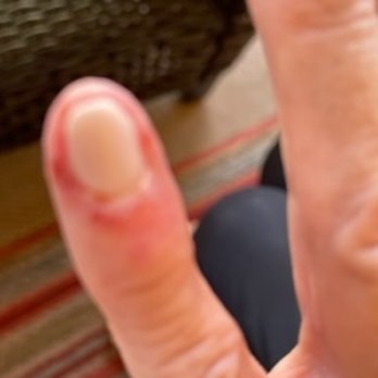 Krazy Nails - Infected!! - Nail Salons Near Me - Peoria, Arizona Krazy Nails - Infected!! - Nail Salons Near Me - Peoria, Arizona