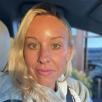DV Beauty - 7 day's after chemical peel. - Skin Care Near Me - Claremont, California DV Beauty - 7 day's after chemical peel. - Skin Care Near Me - Claremont, California