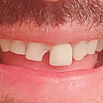 Chino Aesthetic Dental - Before. - Cosmetic Dentists Near Me - Chino, California Chino Aesthetic Dental - Before. - Cosmetic Dentists Near Me - Chino, California