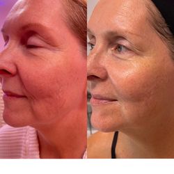 Puritie Spa & Studios - 3 Advanced Plasma Treatments, 2 Age Defying Facials