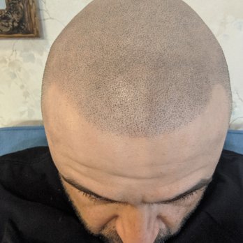 Scalp Micro USA - SMP Treatment by Jesus at Scalp Micro USA - Hair Loss Centers Near Me - Los Angeles, California Scalp Micro USA - SMP Treatment by Jesus at Scalp Micro USA - Hair Loss Centers Near Me - Los Angeles, California