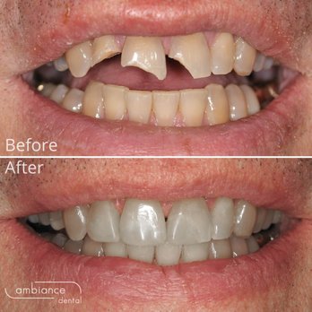Ambiance Dental - This Calgary patient's smile was restored after a bike accident, with cosmetic dentistry - General Dentistry Near Me - Calgary, Alberta Ambiance Dental - This Calgary patient's smile was restored after a bike accident, with cosmetic dentistry - General Dentistry Near Me - Calgary, Alberta