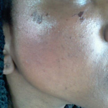 American Nails Spa - Day 3 of the horrible waxing - Nail Salons Near Me - Woodland, California American Nails Spa - Day 3 of the horrible waxing - Nail Salons Near Me - Woodland, California