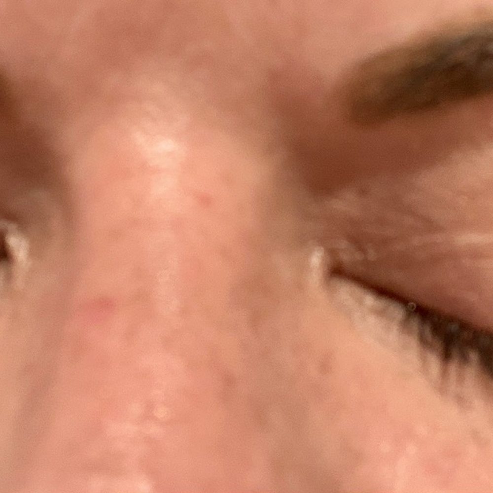 Right eye good. Left eye loss. 26 days only. Right eye good. Left eye loss. 26 days only.