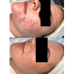 Acne Specialists of Nashville - Booking: nashvilleacne.com
