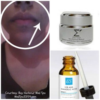 Eva Taub Skin Renewal Method - Lip corners discoloration treated with MINI EVA SKIN LIGHTENING HOME KIT. - Skin Care Near Me - Newnan, Georgia Eva Taub Skin Renewal Method - Lip corners discoloration treated with MINI EVA SKIN LIGHTENING HOME KIT. - Skin Care Near Me - Newnan, Georgia