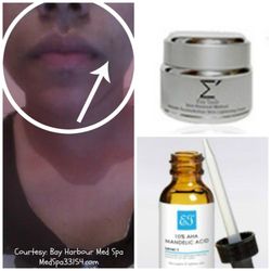 Eva Taub Skin Renewal Method - Lip corners discoloration treated with MINI EVA SKIN LIGHTENING HOME KIT.