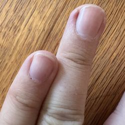 Tk Nail Bar - Blood on cuticle and skin cut by nail.