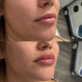 Glam Lab - Lip filler - Medical Spas Near Me - San Jacinto, California Glam Lab - Lip filler - Medical Spas Near Me - San Jacinto, California