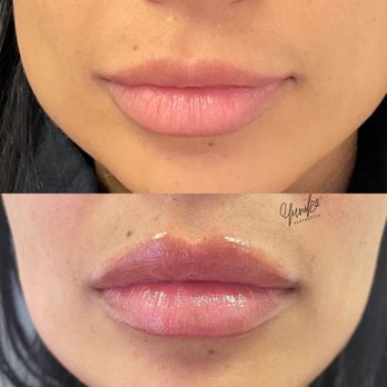Yunik Aesthetics Medspa - Plumpy Pout for this Babe! Treatment: Lip Filler Purpose: hydrate lips, restore volume loss, correct asymmetry. Cost: 500-700 - Medical Spas Near Me - Pembroke Pines, Florida Yunik Aesthetics Medspa - Plumpy Pout for this Babe! Treatment: Lip Filler Purpose: hydrate lips, restore volume loss, correct asymmetry. Cost: 500-700 - Medical Spas Near Me - Pembroke Pines, Florida