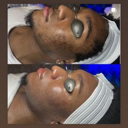 Opulence Wellness & Med spa - Acne Aerolase treatments amazing results great for all skin types and complexions.