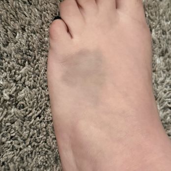 Palladium Nightclub - The bruise on my foot from the table falling on it. - Dance Clubs Near Me - Modesto, California Palladium Nightclub - The bruise on my foot from the table falling on it. - Dance Clubs Near Me - Modesto, California