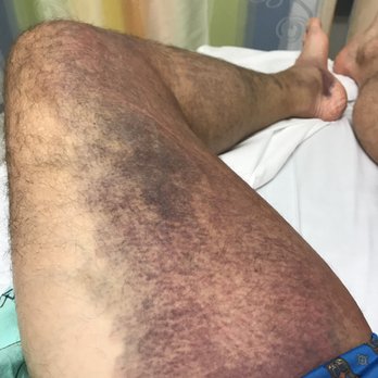 OrthoPro Physical Therapy - Bruising and swelling from left hamstring tear - Physical Therapy Near Me - New York, New York OrthoPro Physical Therapy - Bruising and swelling from left hamstring tear - Physical Therapy Near Me - New York, New York