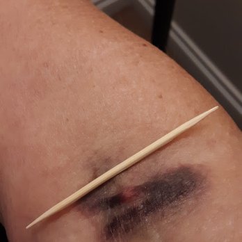 Quest Diagnostics - Three days after. - Laboratory Testing Near Me - Seal Beach, California