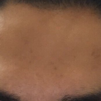Gene Rubinstein, MD, FAAD - After - Dermatologists Near Me - Studio City, California