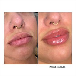 SkinDelish - Lip filler to enhance her beautiful lippies