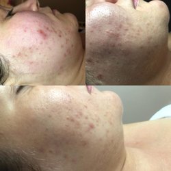 Verdi Beauty Bar - Acne Treatments