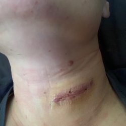Baylor Scott & White Surgical Hospital - Las Colinas - Right after surgery