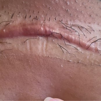 Moelleken Plastic Surgery - Huge scar 9 months post. He never offered any help - Cosmetic Surgeons Near Me - Beverly Hills, California Moelleken Plastic Surgery - Huge scar 9 months post. He never offered any help - Cosmetic Surgeons Near Me - Beverly Hills, California