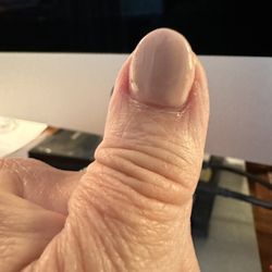 1 Solar Nails - Left thumb with all the red and flaking skin
