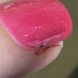 Side of nail cut by filing Side of nail cut by filing