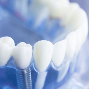 Olathe Dental Care Center - General Dentistry Near Me - Olathe, Kansas Olathe Dental Care Center - General Dentistry Near Me - Olathe, Kansas