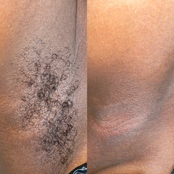 Blissful Skin Esthetics - Under arm wax // before & After - Waxing Near Me - Las Vegas, Nevada Blissful Skin Esthetics - Under arm wax // before & After - Waxing Near Me - Las Vegas, Nevada