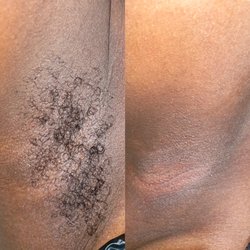 Blissful Skin Esthetics - Under arm wax // before & After