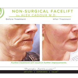 Cadoux Botox Center - Gradual, Natrual, Long-Lasting Results! Stunning work by Dr.Cadoux.