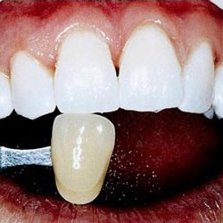 Toussaint Salon Suites - Teeth Whitening After (Photo A)