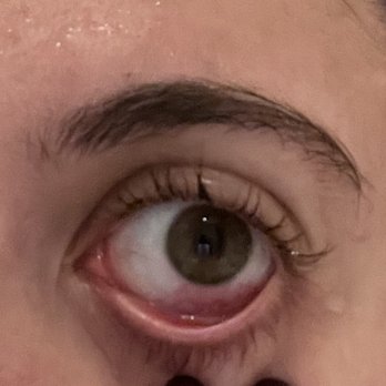 Blink Lash Club - This is what my eyeball looks like two days after the appointment. Save yourself the pain stay away! - Eyelash Service Near Me - New York, New York Blink Lash Club - This is what my eyeball looks like two days after the appointment. Save yourself the pain stay away! - Eyelash Service Near Me - New York, New York