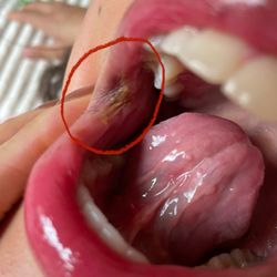 Kidz Dental Care - Bruising on corner of mouth from too much pressure.