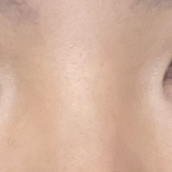YokoMD - post-procedure about 1 month. left eyelid much higher than right - Medical Spas Near Me - Pasadena, California YokoMD - post-procedure about 1 month. left eyelid much higher than right - Medical Spas Near Me - Pasadena, California