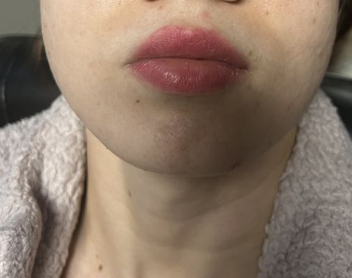 Skin Resurfacing for Acne Scars - C02 Fractional Skin Resurfacing for Acne Scars Skin Resurfacing for Acne Scars - C02 Fractional Skin Resurfacing for Acne Scars