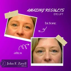 John F. Zavell, MD, FACS - Before & After Results of John F. Zavell, MD, FACS | Toledo, OH