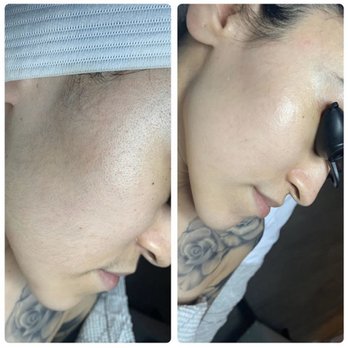 Treatments by MiaD - Before & after dermaplaning with enzymatic treatment! - Estheticians Near Me Treatments by MiaD - Before & after dermaplaning with enzymatic treatment! - Estheticians Near Me