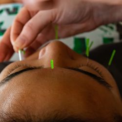 Renew You Acupuncture - Facial Rejuvenation Acupuncture/Cosmetic Acupuncture Treatments.