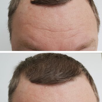 Lime Tree Spa - Scalp Micropigmentation for long hair - Day Spas Near Me - Richmond Hill, Ontario Lime Tree Spa - Scalp Micropigmentation for long hair - Day Spas Near Me - Richmond Hill, Ontario