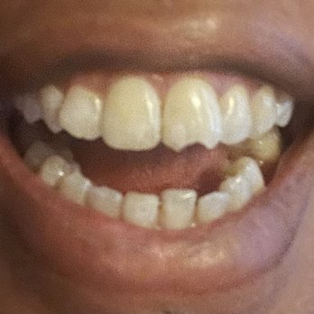 Renton Dental Studio - My chipped tooth - General Dentistry Near Me - Renton, Washington Renton Dental Studio - My chipped tooth - General Dentistry Near Me - Renton, Washington