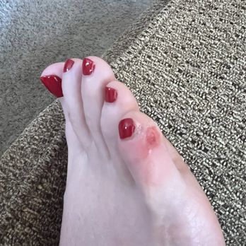Bonita Nails - Damaged pinky toe by Bonita nails - Nail Salons Near Me - Tucson, Arizona