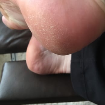 Bamboo Nail Spa - "Callus treatment results" - Waxing Near Me - La Vista, Nebraska Bamboo Nail Spa - "Callus treatment results" - Waxing Near Me - La Vista, Nebraska