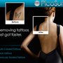 Inklifters Tattoo Removal