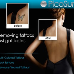 Inklifters Tattoo Removal