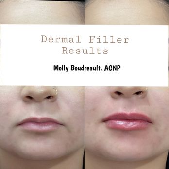 Illuminate Plastic Surgery - Lip filler results by our aesthetic nurse practitioner, Molly Boudreault - Skin Care Near Me - San Jose, California Illuminate Plastic Surgery - Lip filler results by our aesthetic nurse practitioner, Molly Boudreault - Skin Care Near Me - San Jose, California