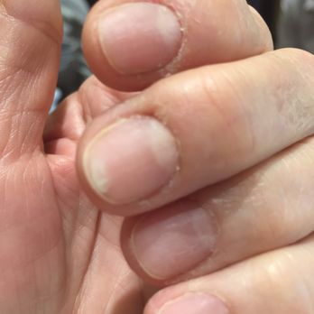 Royal Retreat Pedispa - after my cuticles were  "cleaned". The management didn't seem to care. All the manager could say was "Happy Thanksgiving!" - Nail Salons Near Me - Houston, Texas