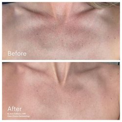 Clear Choice Dermatology - Salem - After 1 Vi Body Peel
