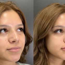 Chin Up! Aesthetics - Before and After!
