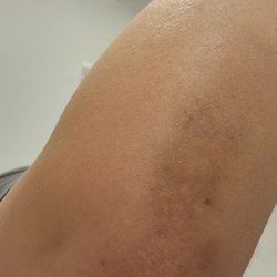 Chiropractic Family Health Centre - Arm/elbow-one year later