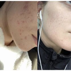 Reina Beauty - Before and After Chemical Peel Series