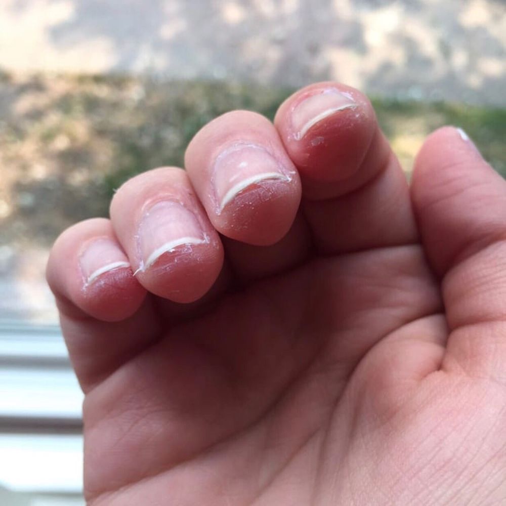 My fingers were shredded My fingers were shredded